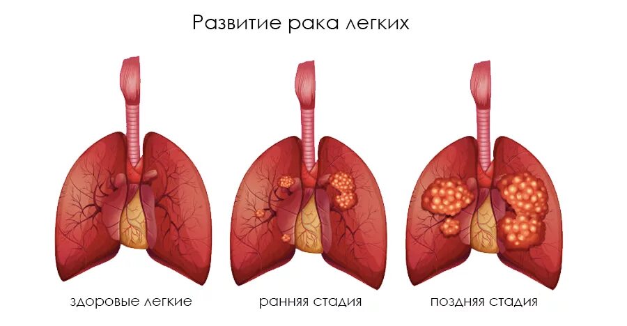 Рак легких 4 стадия фото 1 августа - Всемирный день борьбы с раком легкого - Центр охраны материнства и д