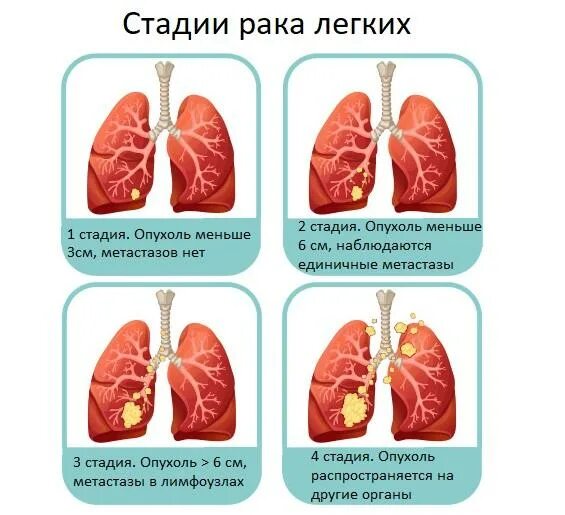 Рак легких 4 стадия фото Можно ли выявить рак легких на ранних стадиях? - запись к врачам в Москве