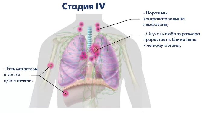 Рак легких 4 стадия фото Рак легких на 4-ой (Четвертой) стадии, симптомы, признаки, диагностика и методы 