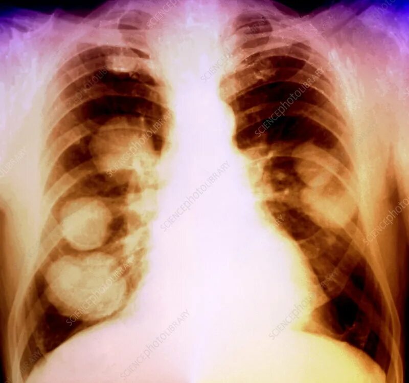 Рак легких 4 стадия фото Lung cancer, X-ray - Stock Image - M134/0621 - Science Photo Library