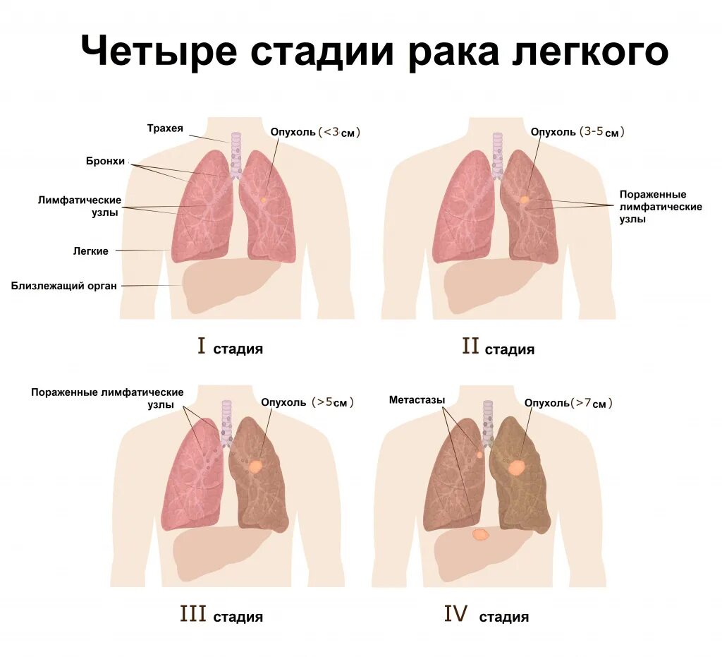 Рак легких симптомы у мужчин фото Рак легкого - причины появления, симптомы заболевания, диагностика и способы леч