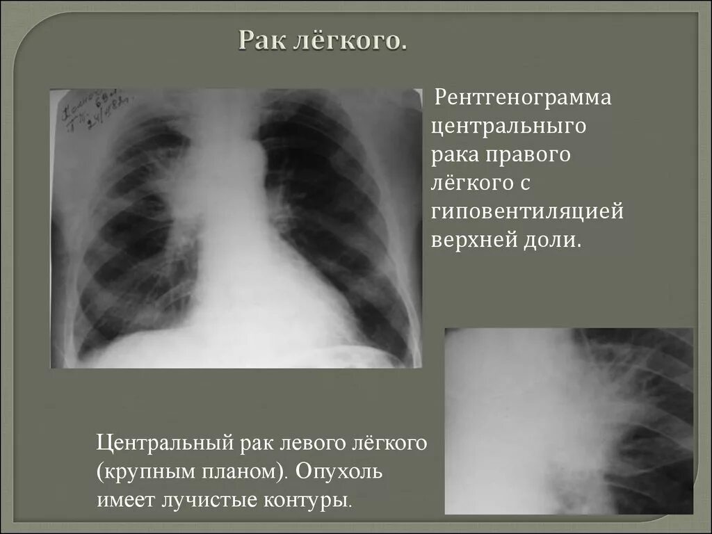 Рак легкого первые симптомы фото Лучистое образование в легких: найдено 71 изображений