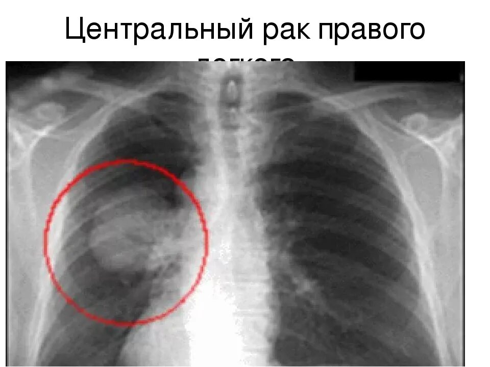 Рак легкого первые симптомы фото Рентген показывает метастазы