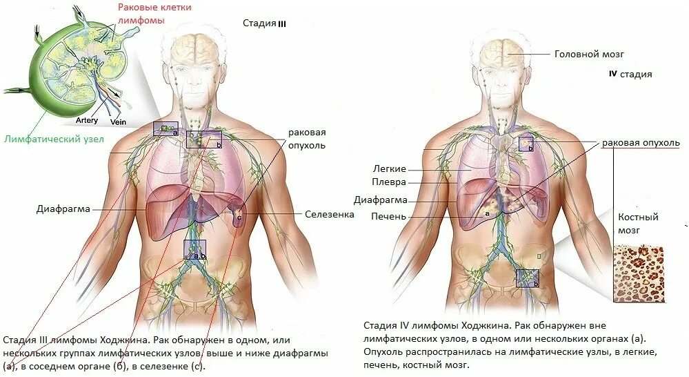 Рак лимфатической системы фото Лечение лимфомы в Израиле без операции с благоприятным прогнозом