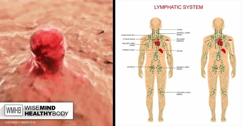 Рак лимфатической системы фото Let’s talk about the sewer system of your body. Did you know thelymphatic system