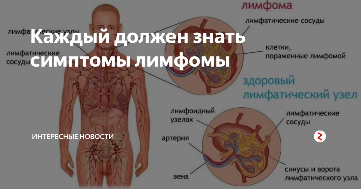 Рак лимфатической системы фото Инфекции лимфатической системы