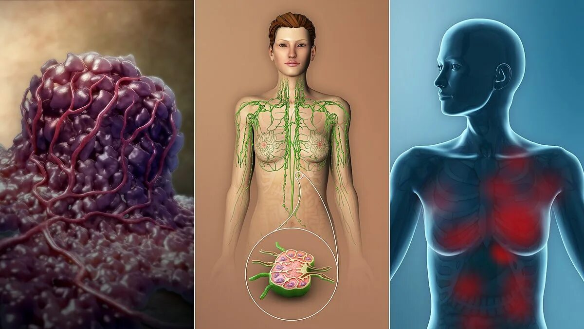 Рак лимфатической системы фото File:3D medical animation TNM Staging System.jpg - Wikipedia