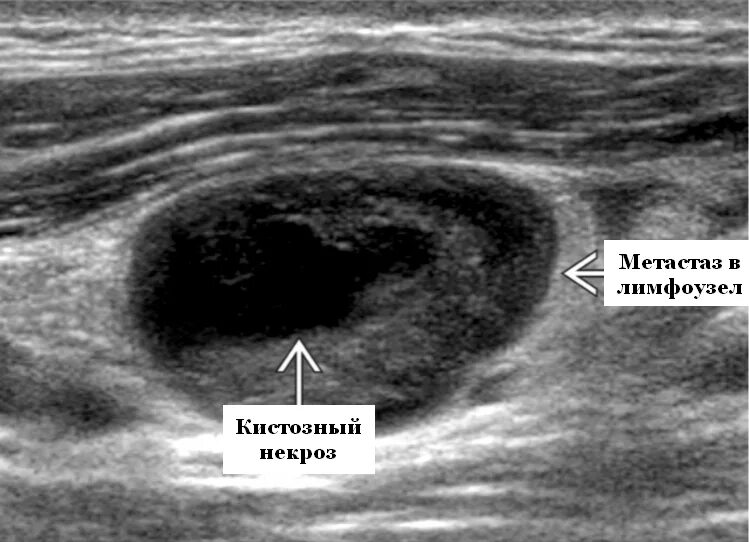 Рак лимфоузлов симптомы фото Лимфоузлы при плоскоклеточной карциноме на УЗИ - УЗИ в Красноярске