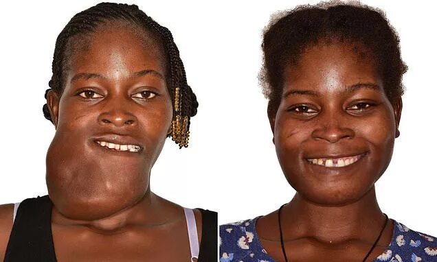 Рак лица фото Woman, 23, stoned by African villagers has giant facial tumour removed after eig