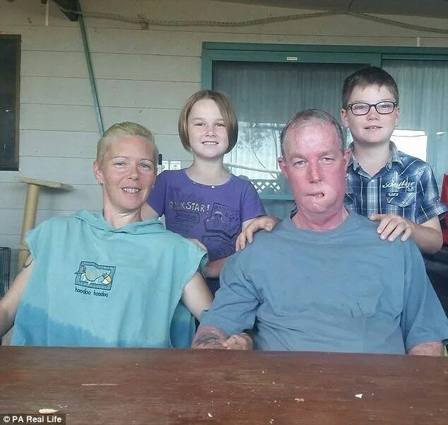 Рак лица фото Father-of-two's 'cold sore' turned out to be cancer Daily Mail Online