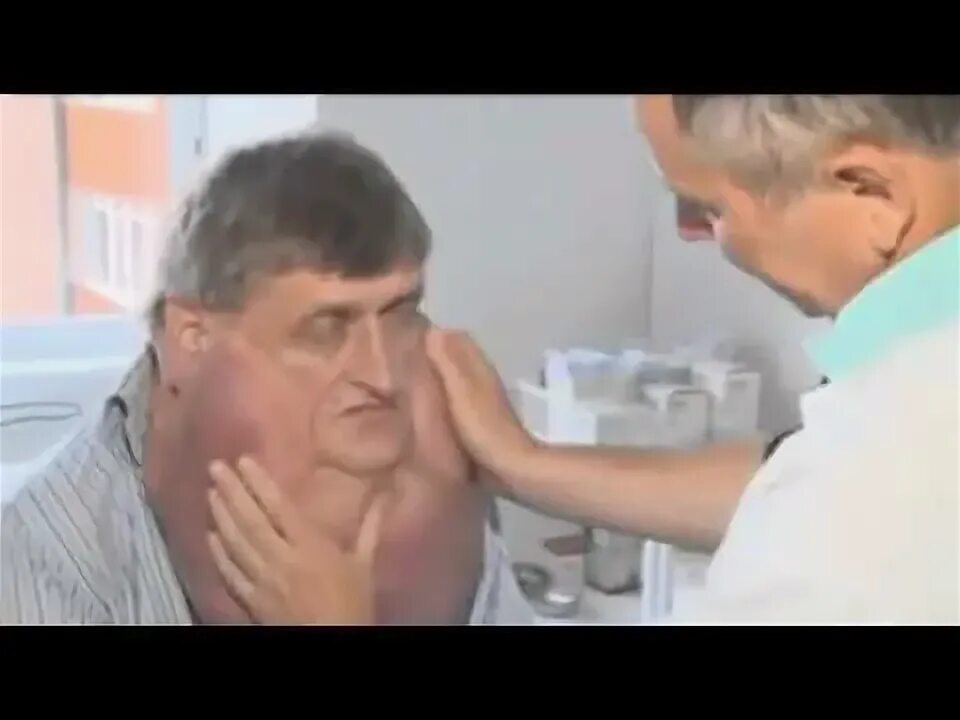 Рак лица фото Man gets 13 pound Tumor Removed from his Face - YouTube