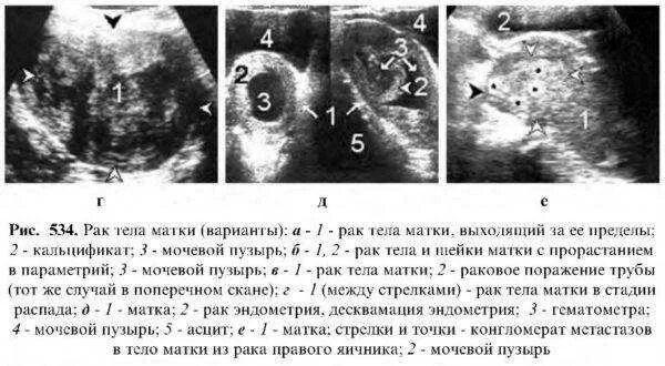 Рак матки первой стадии фото Лейкоплакия шейки матки: начнется ли рак