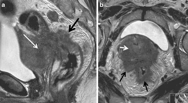 Рак матки первой стадии фото Imaging of endometrial and cervical cancer Insights into Imaging