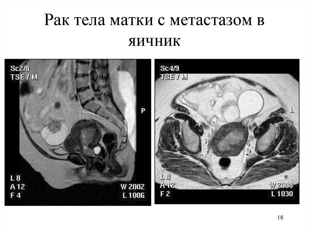 Рак матки первой стадии фото Метастазы рака шейки матки - найдено 83 картинок