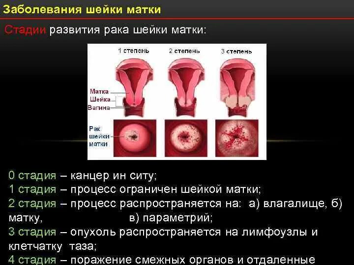 Рак матки первой стадии фото Ршм 1 стадия