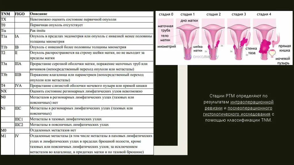 Рак матки первой стадии фото Рак матки клинические