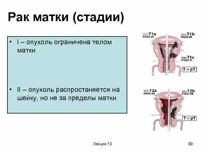 Рак матки первой стадии фото Рак матки нулевая стадия