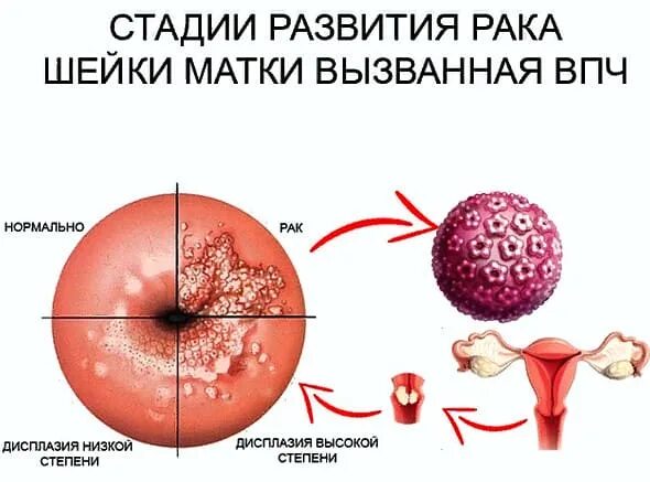 Профилактика рака шейки матки