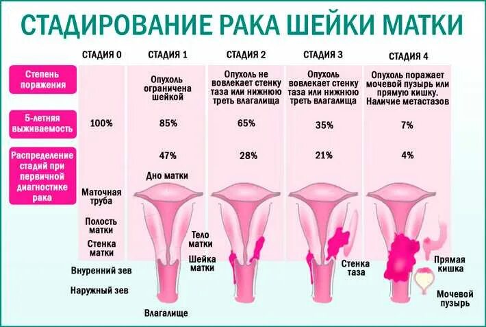 Рак матки признаки симптомы фото Матка может что это может быть: найдено 29 изображений