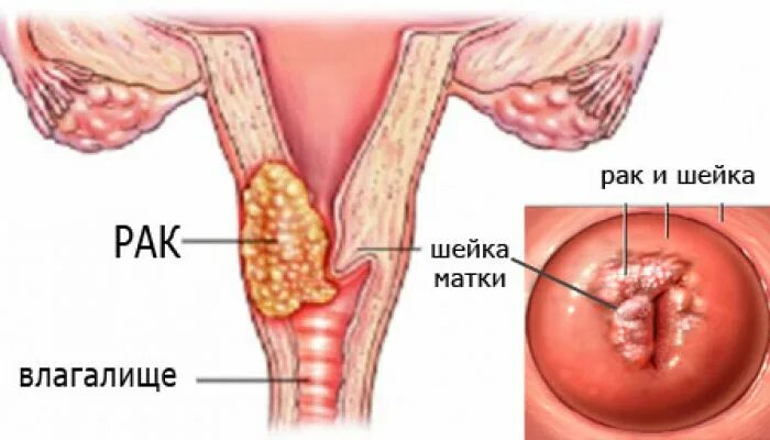 Рак матки признаки симптомы фото Рак шейки матки: симптомы, диагностика и лечение "Санталь Новосибирск" (на Левом