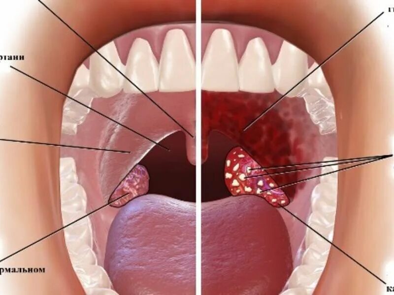 Рак миндалин фото как выглядит в горле Как не болеть простудными заболеваниями часть 2. Есть терпение - будет и умение 