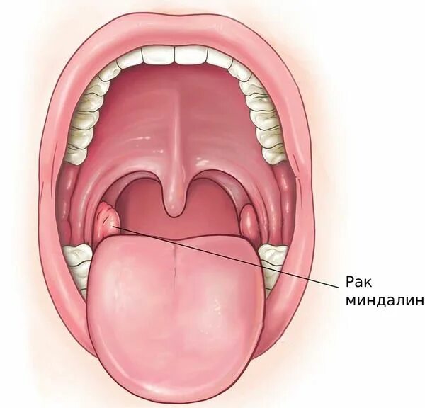 Рак миндалин фото как выглядит в горле Рак миндалин: причины, симптомы и лечение в статье ЛОР-хирурга Мамедов М. М.