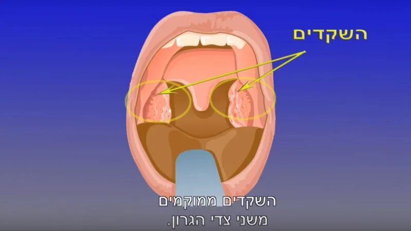 Рак миндалин фото начальная стадия המדריך הרפואי אסותא