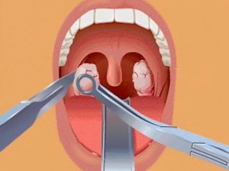 Рак миндалин симптомы фото Paratonsillar abscess in Tashkent Treatment