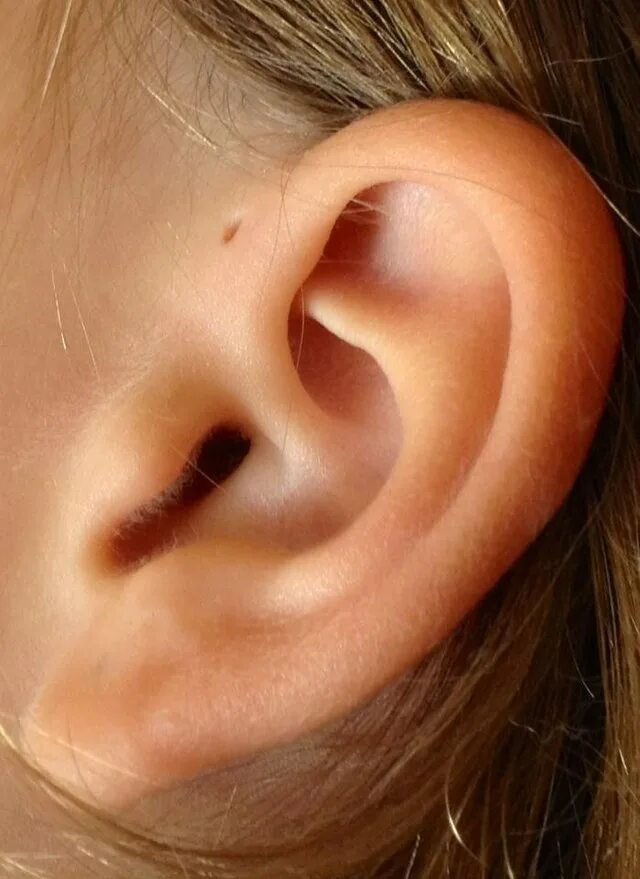 Рак мочки уха фото File:Preauricular sinus and cyst.jpg - Wikipedia