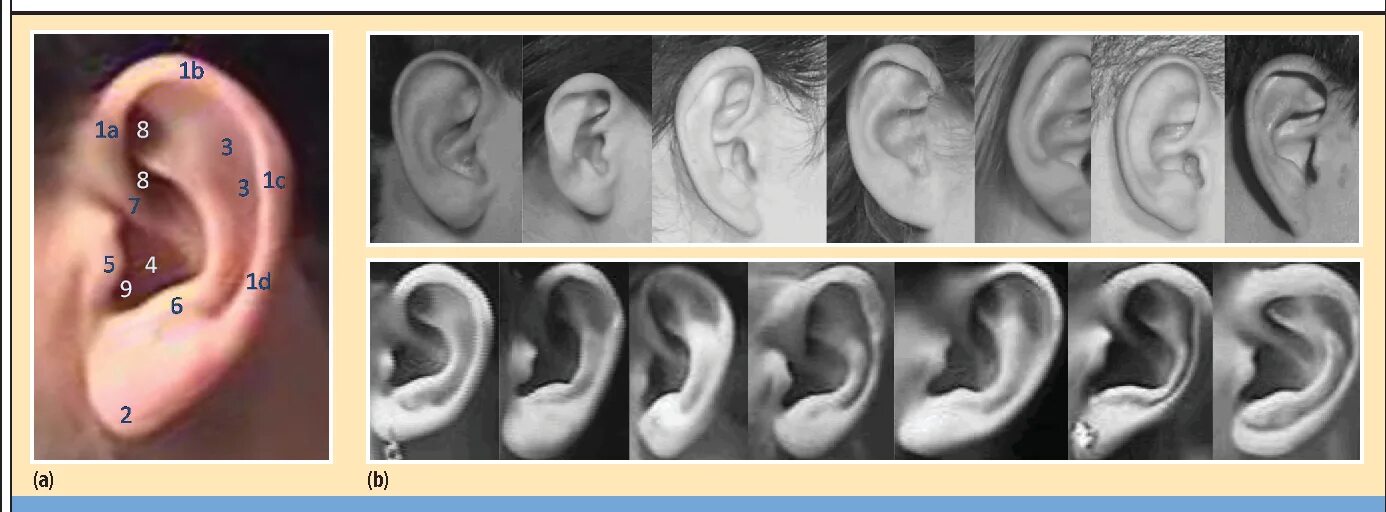 Рак мочки уха фото Figure 1 from Human Ear Recognition Semantic Scholar