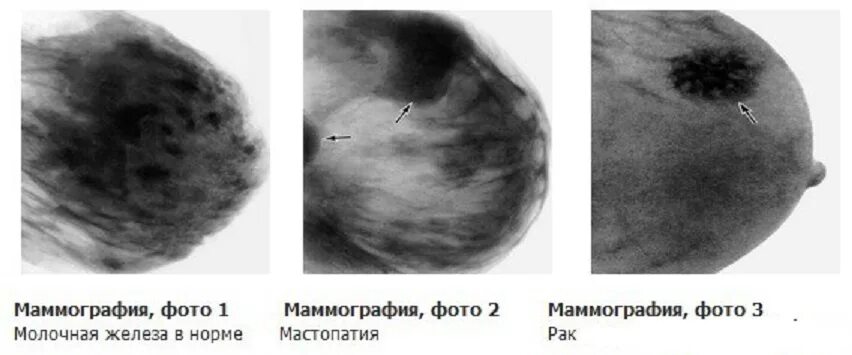 Рак молочной железы симптомы фото Рак груди 4 стадии: симптомы, лечение, прогноз патологии