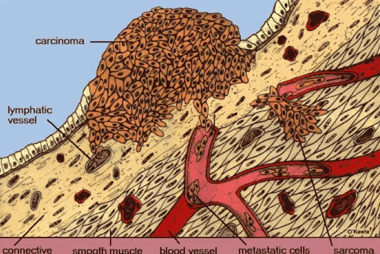 Рак мягких тканей фото Саркома мягких тканей её виды диагностика и лечение Рак - лечение и профилактика
