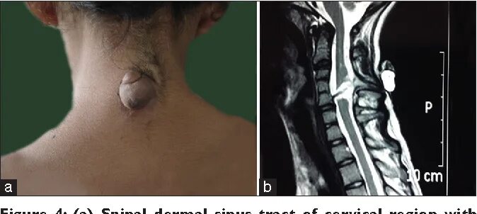 Рак мягких тканей фото Figure 4 from Spinal dorsal dermal sinus tract: An experience of 21 cases Semant