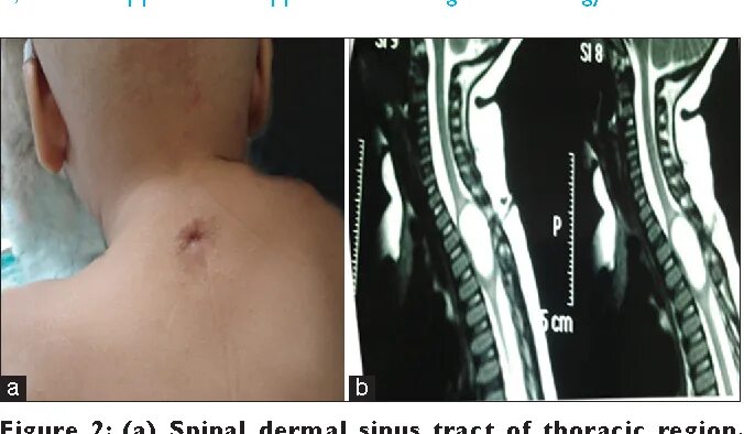 Рак мягких тканей симптомы фото Figure 2 from Spinal dorsal dermal sinus tract: An experience of 21 cases Semant