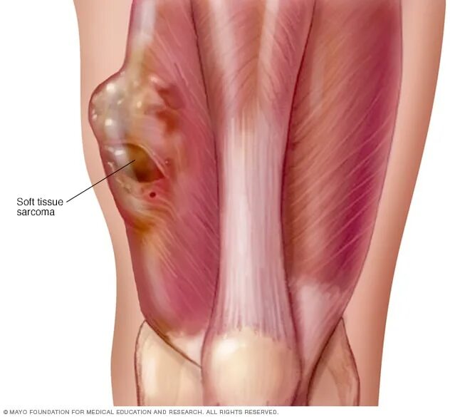 Рак мягких тканей симптомы фото Soft tissue sarcoma - Mayo Clinic