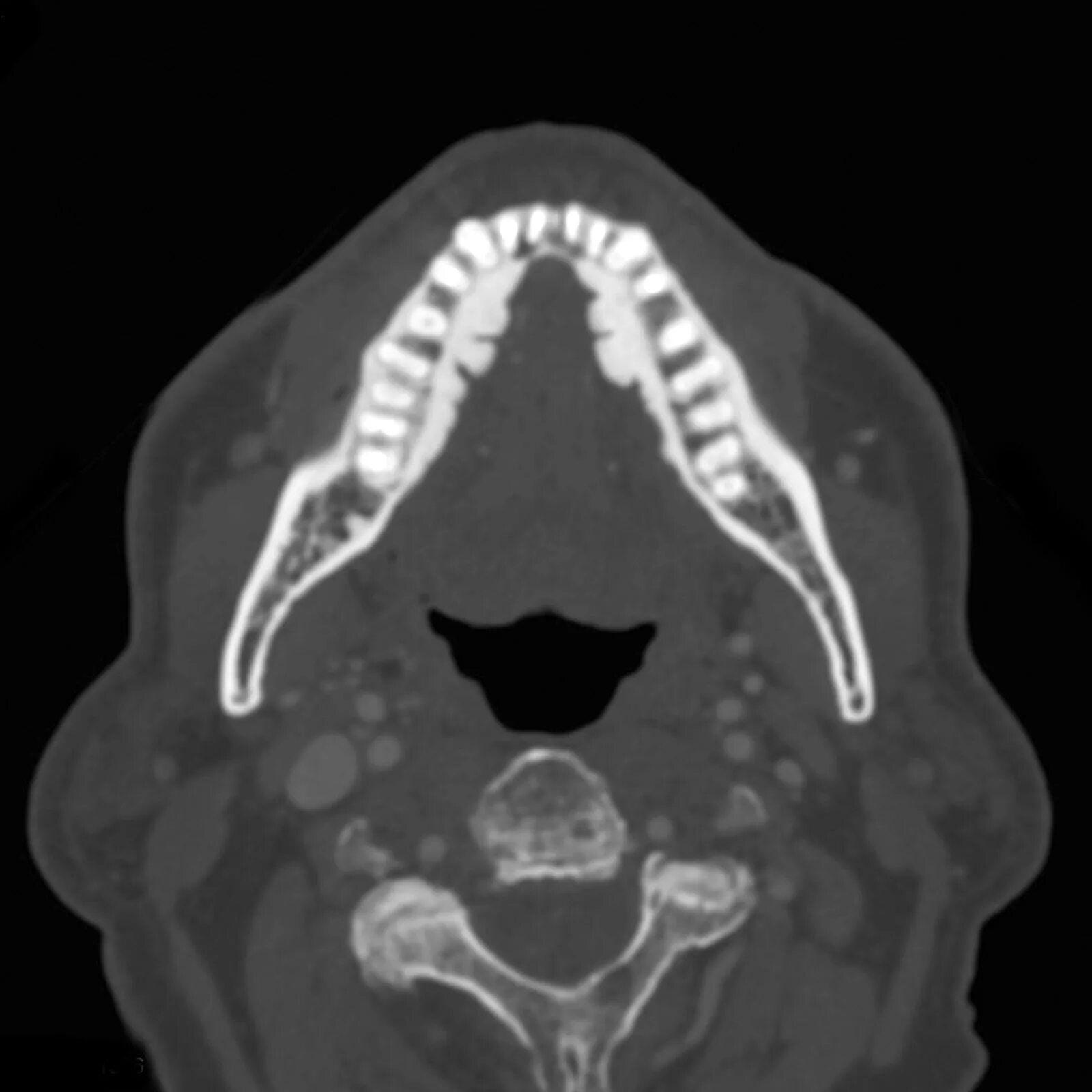 Рак мягкого неба фото Image Radiopaedia.org