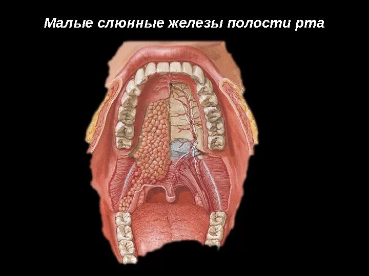 Рак мягкого неба фото Анатомия слюнных желез Воспалительные заболевания слюнных желез