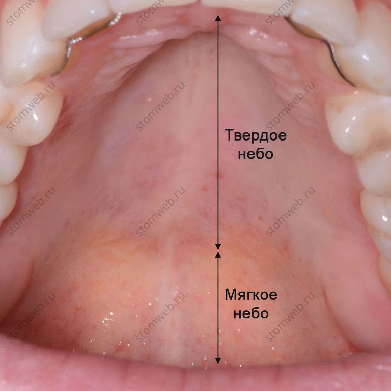 Рак мягкого неба фото симптомы Мягкое небо - STOMWEB - Твердое и мягкое нёбо