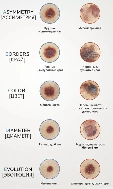 Acquired Hypertrichosis Lanuginosa New England Journal of Medicine