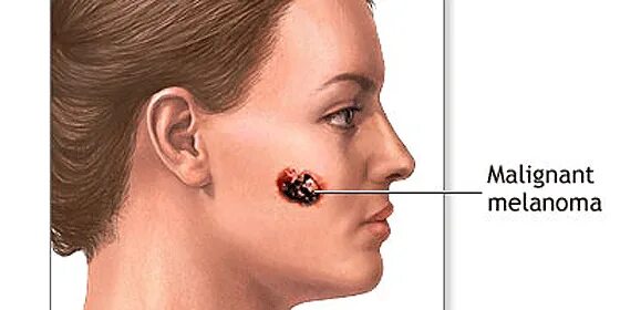 Рак на лице фото начальная Los siete signos de alarma del melanoma - Periodista Digital