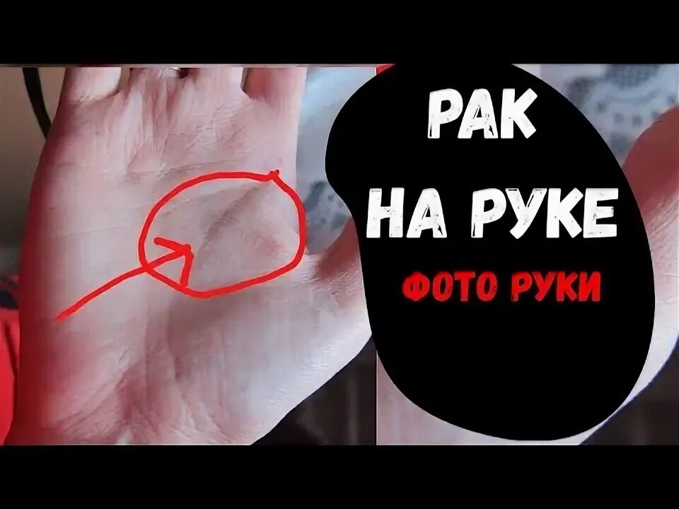 Рак на руке фото как выглядит Рак, Онкология /Хиромантия - YouTube