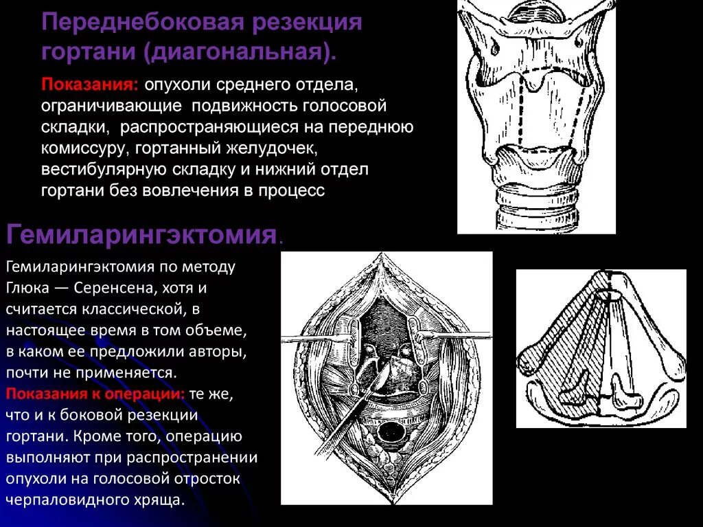 Рак надскладочного отдела гортани фото Анатомия гортани - презентация онлайн