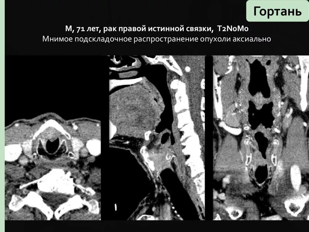 Рак надскладочного отдела гортани фото КТ-диагностика злокачественных опухолей ротовой полости, глотки, гортани