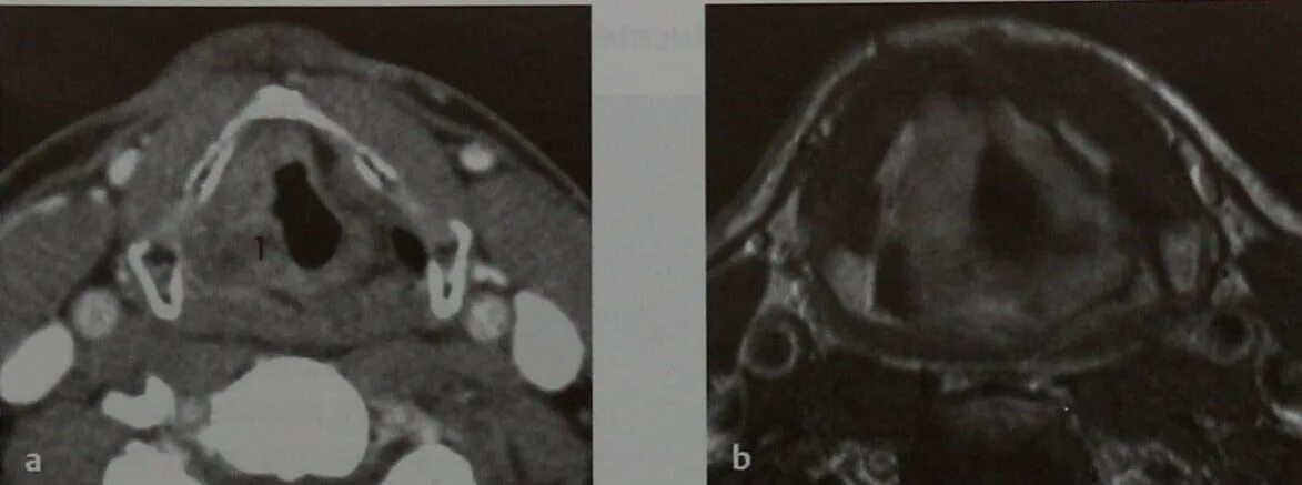 Рак надскладочного отдела гортани фото МРТ и КТ пазух носа. Диагностика опухолей надскладочного пространства и глотки