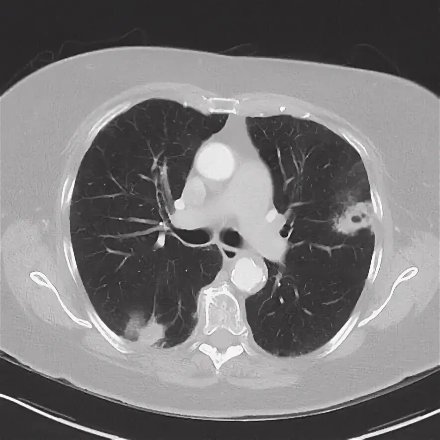 Рак неба фото Synchronous primary lung carcinoma Radiology Reference Article Radiopaedia.org