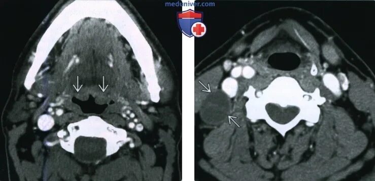 Рак неба фото и признаки ВПЧ-обусловленный плоскоклеточный рак ротоглотки - лучевая диагностика