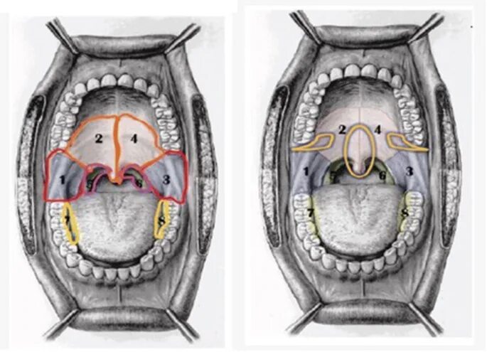 Рак неба фото начальная Minimally invasive erbium laser treatment for selected snorers Lasers in Medical