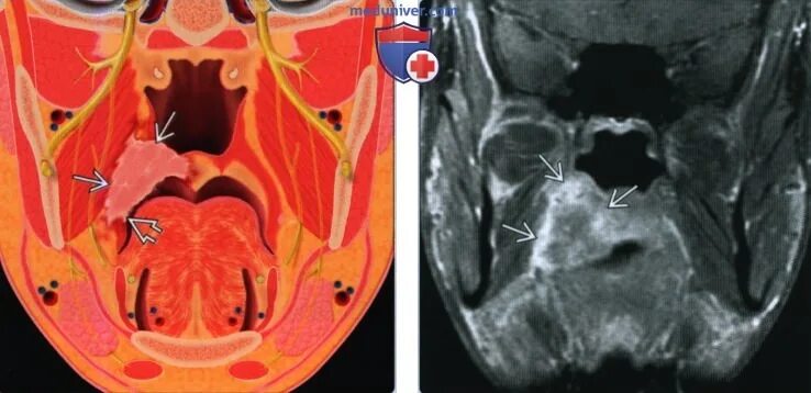 Рак неба симптомы фото и признаки КТ, МРТ при плоскоклеточном раке мягкого неба