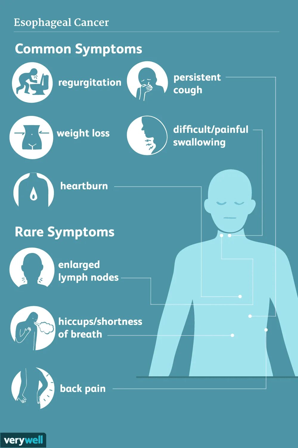 Рак неба симптомы фото и признаки Esophageal Cancer: Signs and Symptoms