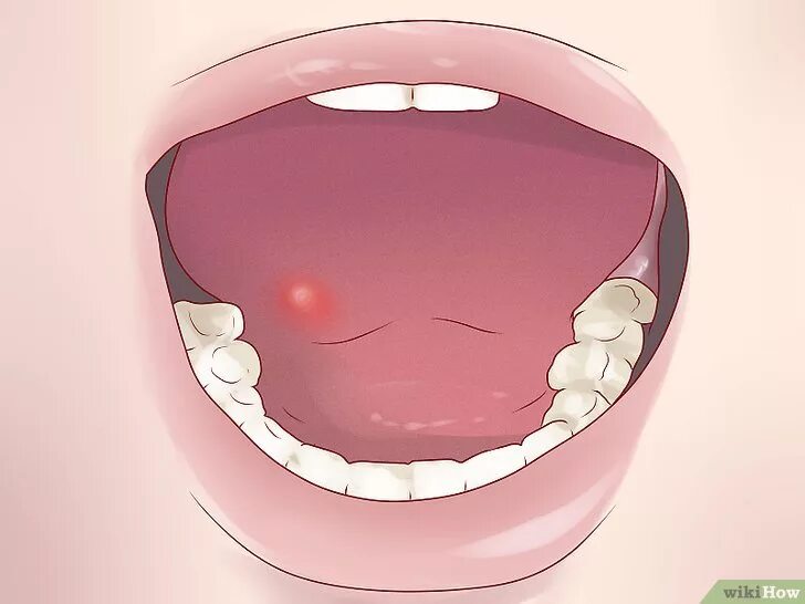 Рак неба во рту фото Leukoplakia of the oral cavity: a pathology dangerous to health